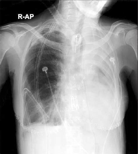 Tracheostomy X Ray