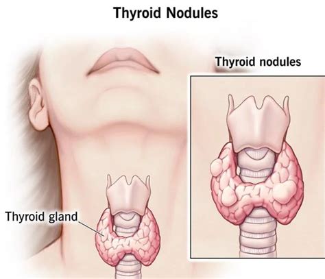 Thyroid Nodule Treatment In Mumbai : What Happens After You Discover A ...