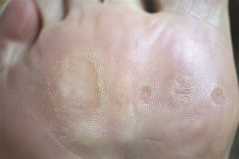 Swift Wart Therapy Before And After Gallery Footpoint Podiatry