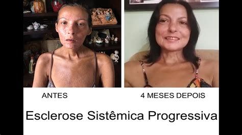 Adriana Esclerose Sistêmica Progressiva Esclerodermia YouTube