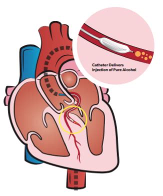 Alcohol Septal Ablation Arkansas Heart Hospital