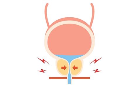 Premium Vector Medical Illustration Of Benign Prostatic Hyperplasia