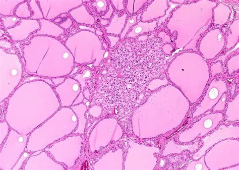 Graves Disease Pathology