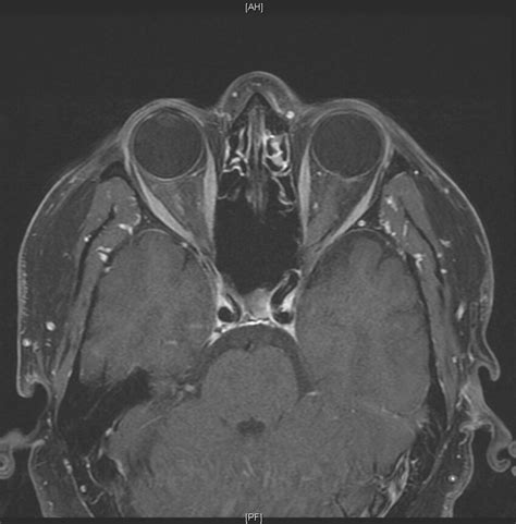 T1 Weighted Post Contrast Axial Mri Of The Orbit Showing Interval