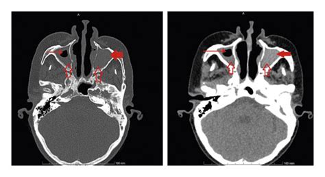 Axial Paranasal Ct Showed Significant Hyper Density In Both Maxillary