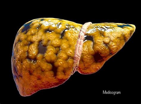 Hepatic Steatosis Fatty Liver Disease Medizzy