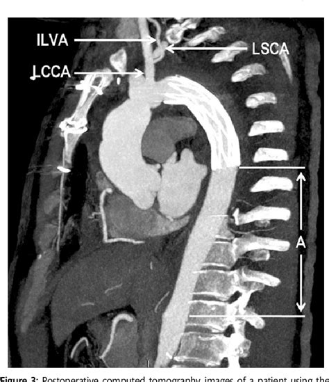 Figure 1 From Repair Of Complicated Type B Dissection With An Isolated