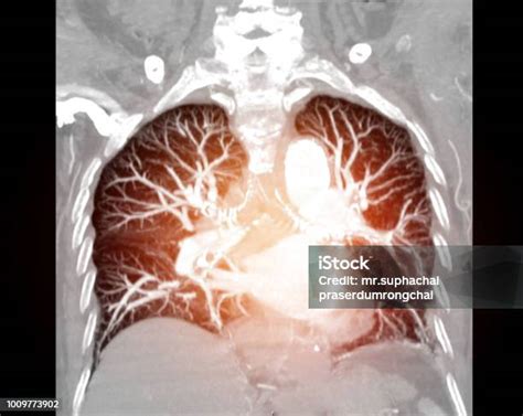 Ct Scan Gambar Di Dalam Dada Manusia Foto Stok Unduh Gambar Sekarang