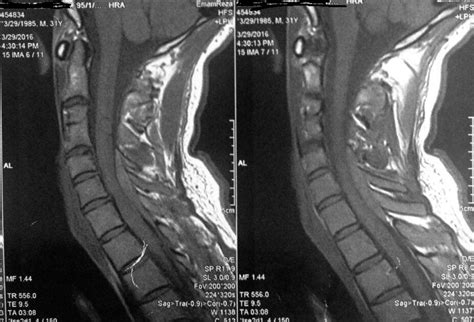 Spontaneous Epidural Hematoma Of Cervical Spine International Journal