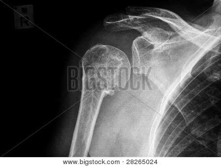 Fracture Proximal Image & Photo (Free Trial) | Bigstock