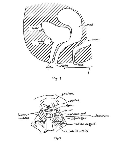 Surgical Systems And Methods For Transvaginal Apical Suspension