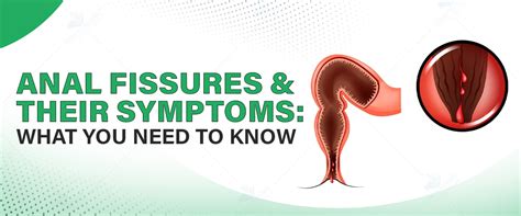 Anal Fissures And Their Symptoms What You Need To Know