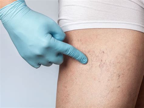 Varicose Vein Treatment Conditions That Qualify For Insurance