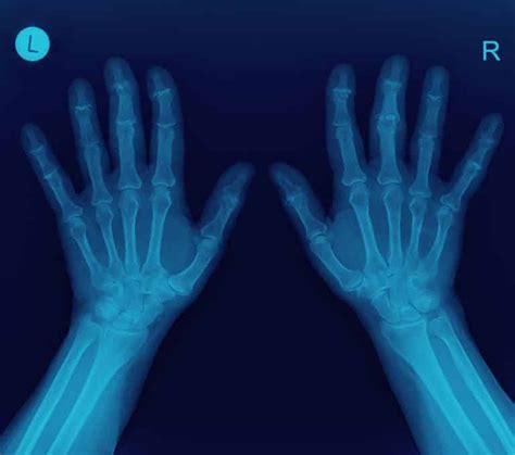 Preparation Low Dose Ct Scan Melbourne Radiology