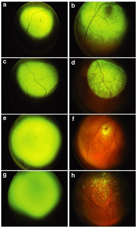 Subretinal Injection Of Aav28 Gfp Vector Into Rats Results In Green