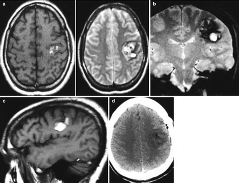 of Surgery for Cavernomas in Critical Supratentorial Areas | Neupsy Key