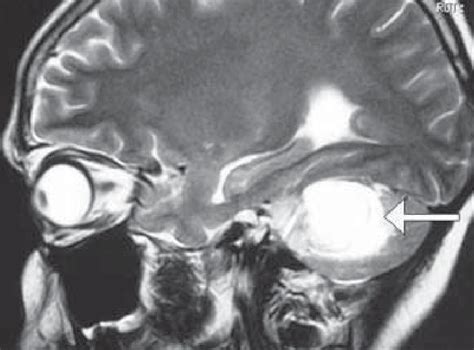 Sagittal section of MRI showing a well-defined lesion on the cerebellum ...