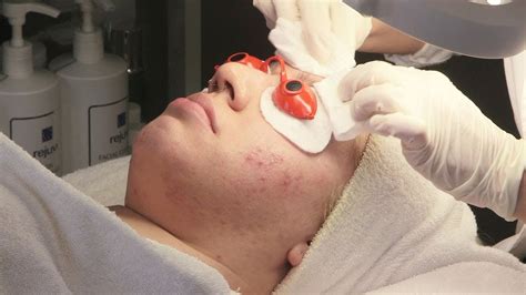 Acne Facial Treatment And Analysis Youtube