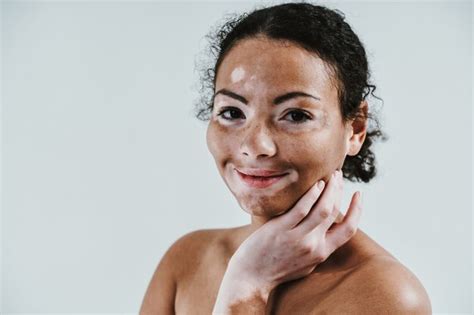 Mulher Bonita Pele Vitiligo Posando No Est Dio Conceito Sobre