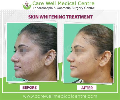 Skin Whitening Treatment In Gurgaon Hot Sale Ruthiesnotions