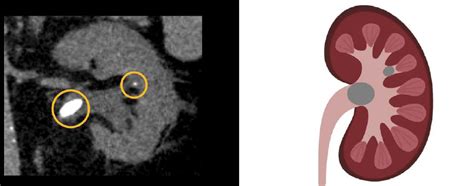 Abdominal CT: renal stones • LITFL • Radiology Library