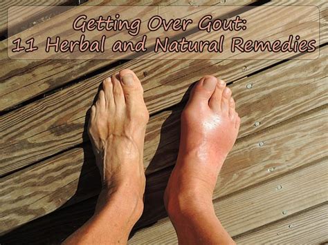 Getting Over Gout 11 Herbal And Natural Remedies