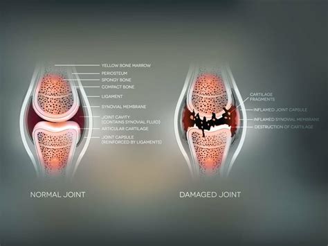 What To Expect During Knee Replacement Recovery Rpt Utah