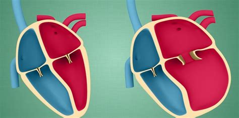 Dilated Cardiomyopathy: Causes, Symptoms, Diagnosis and Treatment ...