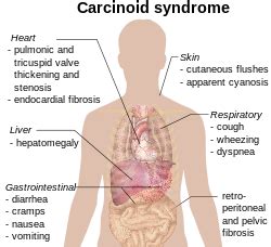 Carcinoid syndrome - Wikipedia