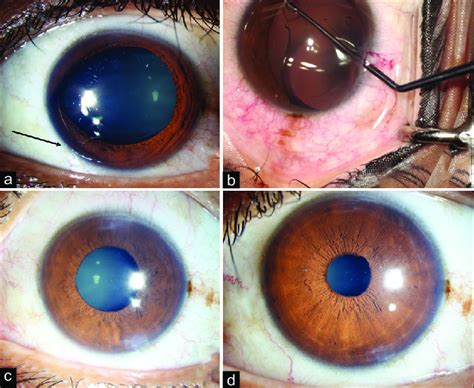 A Slit Lamp Photograph Of Inferonasal Implantable Phakic Contact