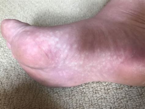 White Spots On Bottom Of Feet Management And Treatment Options For