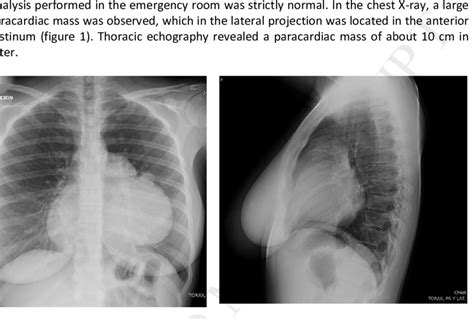 The Chest X Ray Showed A Big Mass Located In Anterior Mediastinum Download Scientific Diagram