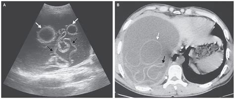 Echinococcal Cysts In The Liver Manual Of Medicine