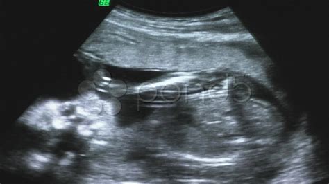 22 Weeks Ultrasound