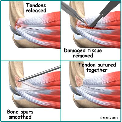 Tennis Elbow Surgery Richmond Va Lateral Epicondyle Release Henrico