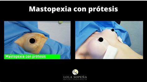 Mastopexia Con Pr Tesis Youtube