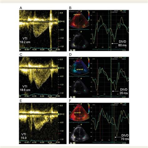 Measurements Of Pulsed Wave Doppler Derived Left Ventricle Outflow Download Scientific Diagram