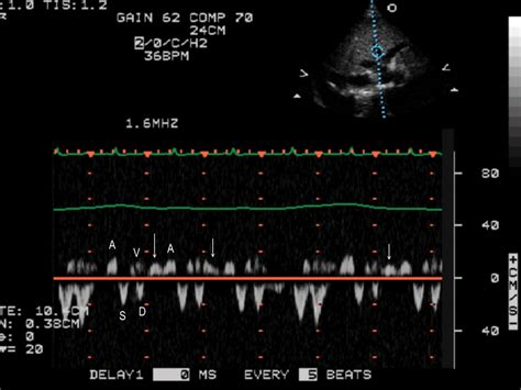 Understanding The Spectral Doppler Waveform Of The Hepatic Veins In