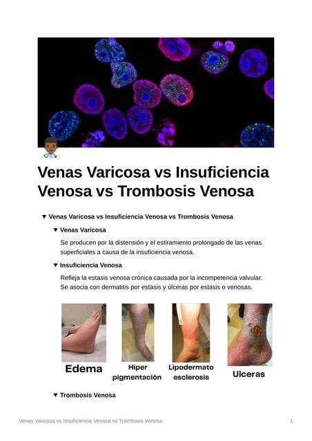 Venas Varicosa Vs Insuficiencia Venosa Vs Trombosis Espm Medicina Udocz