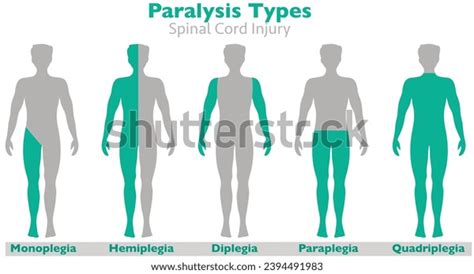 Paralysis Types Spinal Cord Injury Hemiplegia Stock Vector (Royalty ...