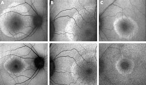 Af Images In Three Patients With Rod Cone Dystrophy And Normal Visual