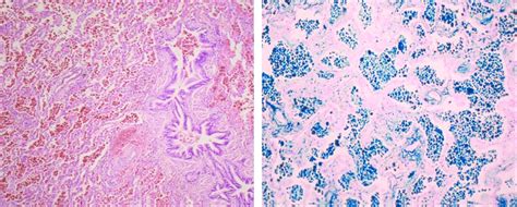 large number  hemosiderin laden macrophages  foci  fresh