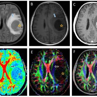 Diffusion Tensor Imaging Of The Brain Of A Year Old Woman With A