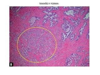 Adenocarcinoma De Prostata Ppt