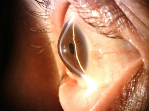 Treating Keratoconus With The CKlear Method Dr Barry Leonard And