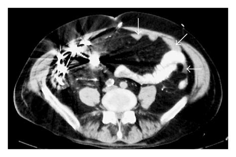 Abdominal CT scan at the level of the iliac crests demonstrates dense ...