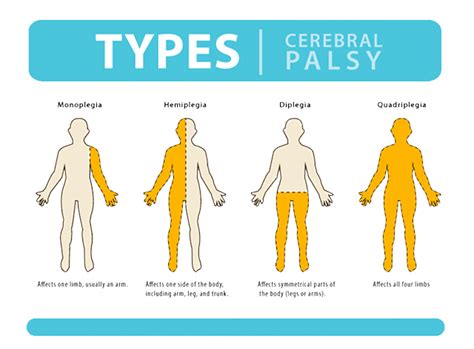 Cerebral Palsy Stem Cell Therapy Treatment India Dr Sagar Jawale