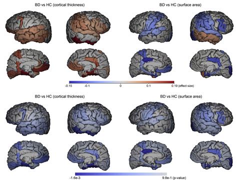 Manic Episodes In Bipolar Disorder Linked To Abnormal Brain Changes