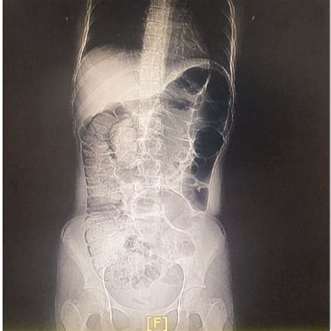 Abdominal Computed Tomography Scan Showing Excessive Intestinal Gas