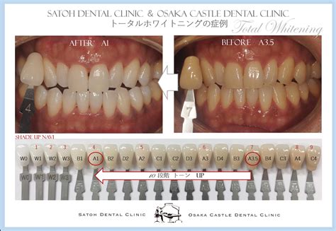 トータルホワイトニング 後編 サトウ歯科｜大阪城デンタルクリニック｜デンタルインプラントクリニック大阪